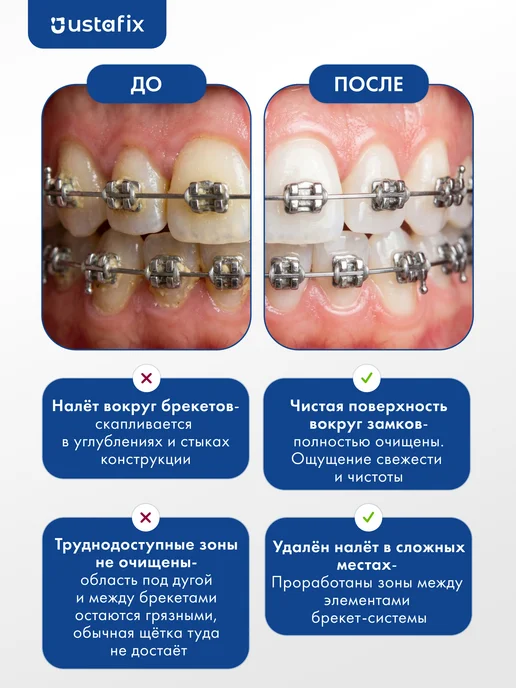 USTAFIX Зубная щетка для брекетов ортодонтическая набор 2 шт, 2 шт, фото 4