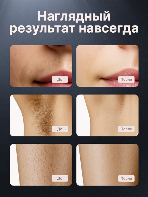 TexnoParts Фотоэпилятор лазерный, бежевый, фото 3